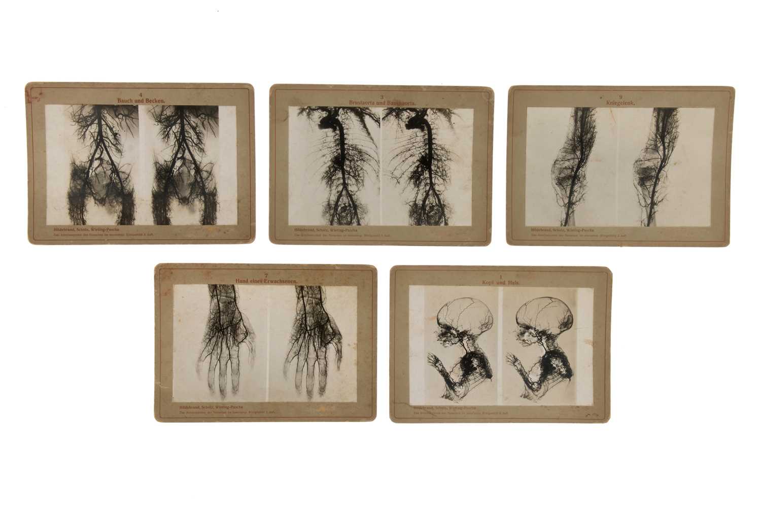 Lot 147 - An Unusual Set of X-Ray Medical Stereocards