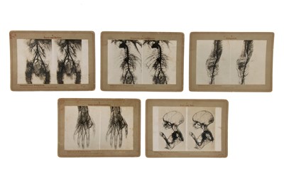 Lot 147C - An Unusual Set of X-Ray Medical Stereocards