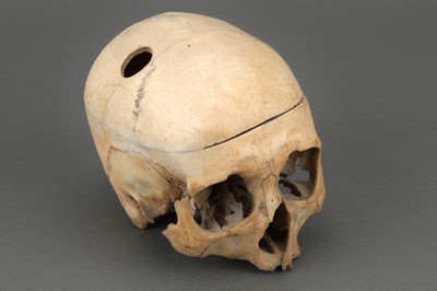 Lot 179 - Victorian Human Skull Showing Surgery